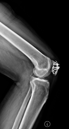 X线照片 膝关节图片