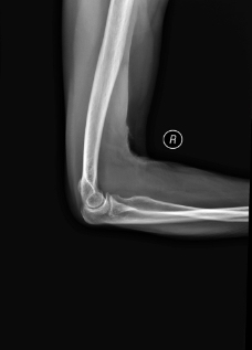 X线照片肘关节图片
