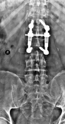 X线照片腰椎图片